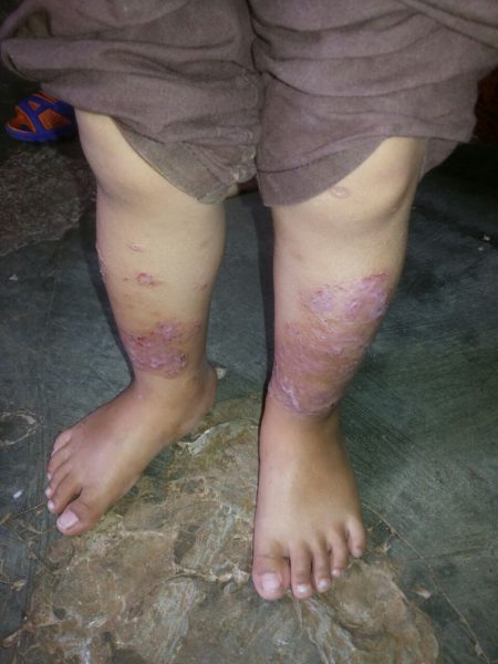 Penyakit kulit melanda sejumlah anak-anak, menyebabkan gatal-gatal dan luka-luka (dok. KM)