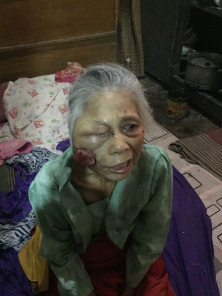 Kondisi Mak Ara, warga Desa Sukaharja, Ciomas, yang menderita tumor di pipi kanannya dan kini terkapar lemas di rumahnya [dok. KM]