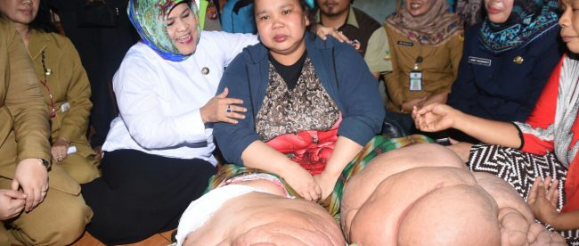 Unih, warga Citeureup penderita penyakit kaki gajah saat dikunjungi oleh Bupati Bogor, Nurhayanti (dok. KM)