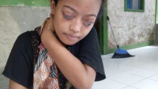 Badriah Ulba (16), gadis yang mengidap penyakit aneh yang menyebabkan dirinya kehilangan penglihatan dan membuat badannya menjadi kurus (dok. Irfan/KM)