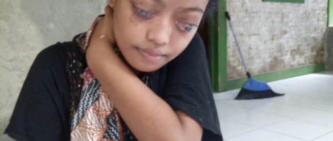 Badriah Ulba (16), gadis yang mengidap penyakit aneh yang menyebabkan dirinya kehilangan penglihatan dan membuat badannya menjadi kurus (dok. Irfan/KM)