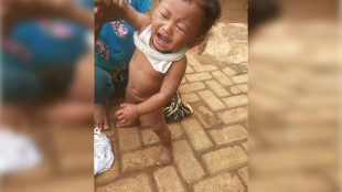 Seorang anak yang menderita penyakit kulit dan gatal-gatal yang diduga akibat pemcemaran limbah TPA Galuga (dok. KM)