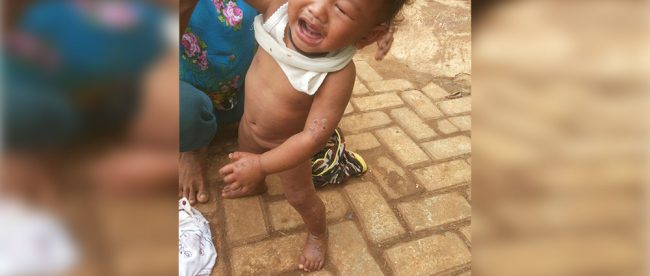 Seorang anak yang menderita penyakit kulit dan gatal-gatal yang diduga akibat pemcemaran limbah TPA Galuga (dok. KM)