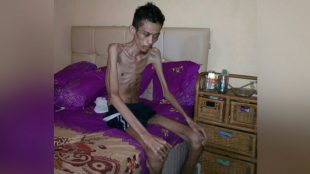 Deri (26), penderita TB usus di Pangkalpinang, Babel (dok. KM)