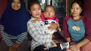 Kondisi penderita penyakit hemangioma Nafeeza Zahra Arifin di kediamannya di Kampung Pintu Dusun III Desa Babelan Kota, Kecamatan Babelan, Kabupaten Bekasi (dok. KM)