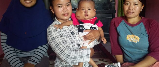 Kondisi penderita penyakit hemangioma Nafeeza Zahra Arifin di kediamannya di Kampung Pintu Dusun III Desa Babelan Kota, Kecamatan Babelan, Kabupaten Bekasi (dok. KM)