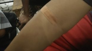 Salah Satu Pasien Program STBP Usai Diambil Sampel Darahnya Oleh Petugas Dinkes Kota Depok (dok. KM)