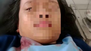 Fakhirah Yasmin Aisah, korban lemparan penggorengan saat merayakan Hari Guru Nasional di halaman Kantor Kecamatan Tamansari, Bogor (dok. KM)