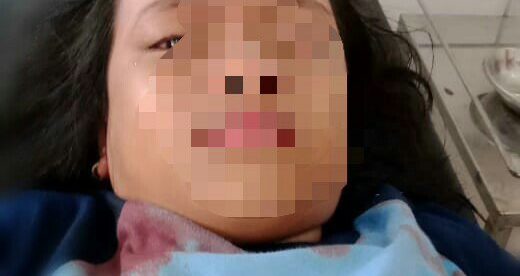 Fakhirah Yasmin Aisah, korban lemparan penggorengan saat merayakan Hari Guru Nasional di halaman Kantor Kecamatan Tamansari, Bogor (dok. KM)